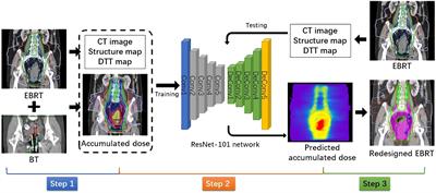 Improvement of accumulated dose distribution in combined cervical cancer radiotherapy with deep learning–based dose prediction